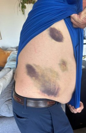 a man in a blue shirt has a lot of bruises on his back