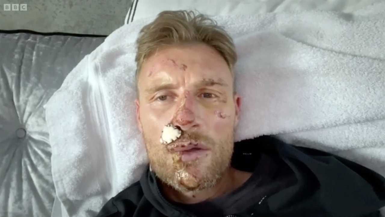 Freddie Flintoff with facial injuries.